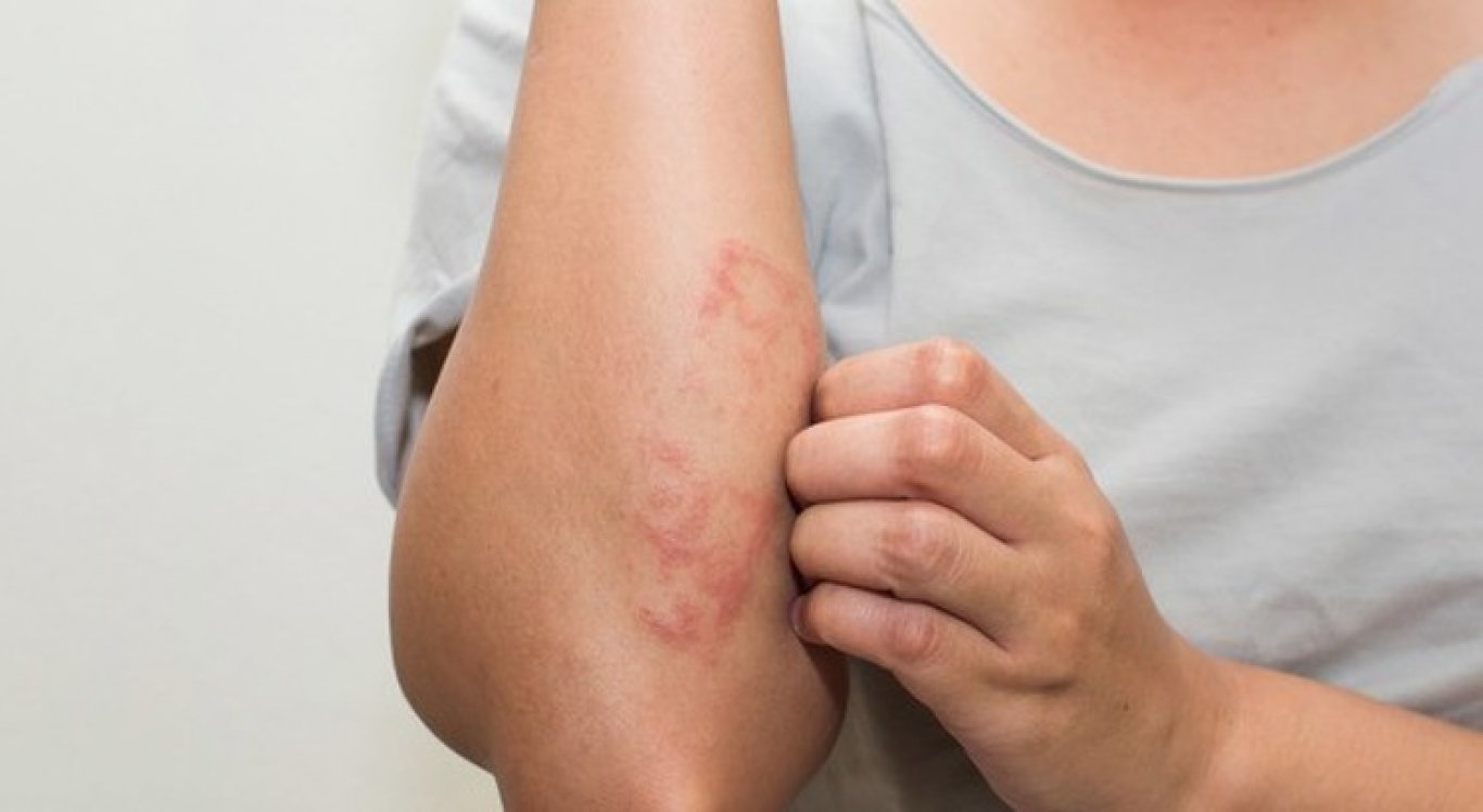 Mais de 200 casos chegaram a ser identificados em duas comunidades em uma área de reserva de Mata Atlântica de um parque do Estado | Foto: reprodução