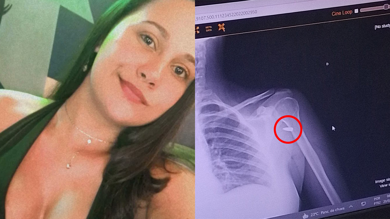 Caso aconteceu no Rio de Janeiro; jovem pensou que era apenas uma pedra, quando desconfiou que poderia ser algo mais grave | Foto: reprodução/Twitter