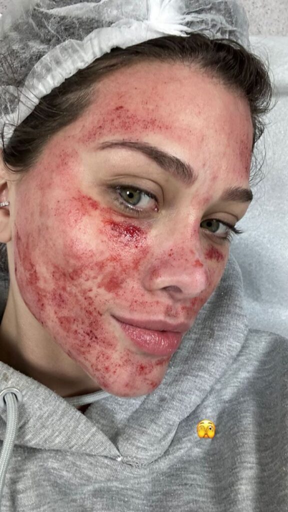 Flávia Pavanelli aparece com rosto sangrando e assusta seguidores