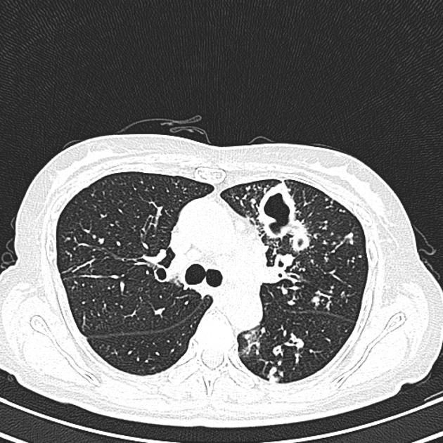 Tuberculose Pulmonar | Foto: Arquivo/Radiopaedia
