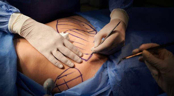 Close up of plastic surgeon hands in sterile gloves using scalpel while doing plastic surgery in clinic. Concept of cosmetic surgery and abdominoplasty.