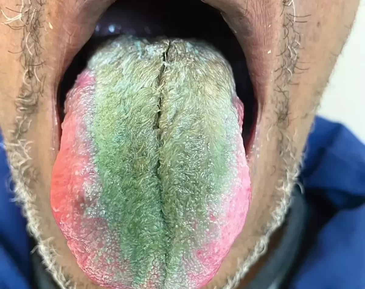 O homem foi ao hospital após sentir mal-estar e coceira na língua | Foto: Reprodução/ Redes Sociais