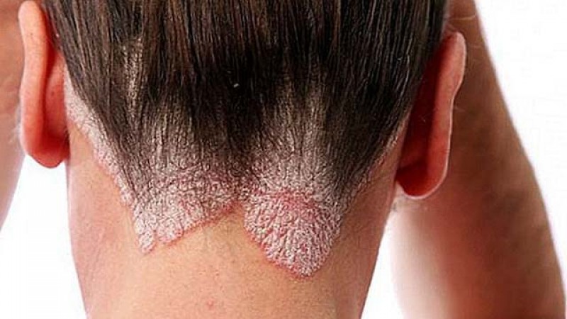 A psoríase é uma doença de pele crônica e não contagiosa (Foto: Reprodução)