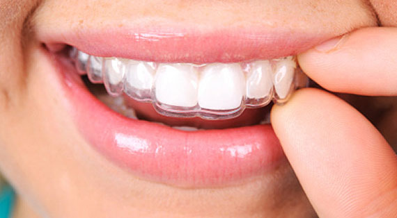 Imagem Ilustrando a Notícia: Cresce a procura por aparelhos dentários mais discretos e funcionais