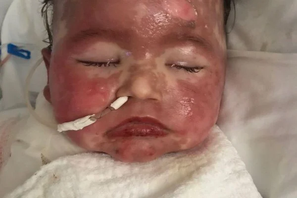 Imagem Ilustrando a Notícia: Bebê que sofreu reação alérgica piora estado e apresenta infecção grave