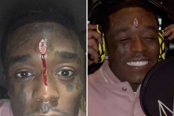 Imagem Ilustrando a Notícia: Diamante de R$ 120 milhões implantado na testa de rapper é arrancado em show