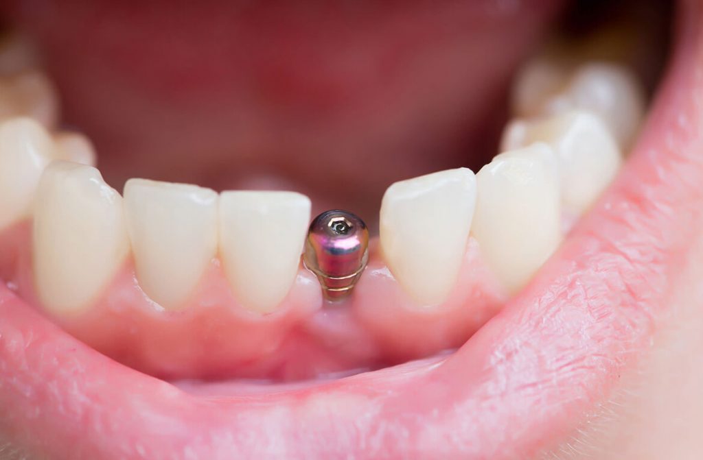 Imagem Ilustrando a Notícia: Implante realizado sem sucesso por dentista gera indenização de 10 mil reais à paciente em Goiânia