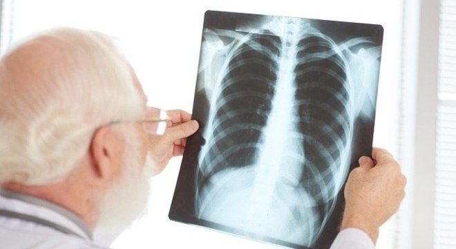 Imagem Ilustrando a Notícia: Conheça os vários tipos de pneumonia e quem é mais suscetíveis para a doença