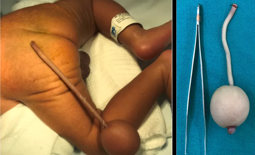 Imagem Ilustrando a Notícia: Conheça o caso do bebê brasileiro que nasceu prematuro com uma cauda de 12 centímetros