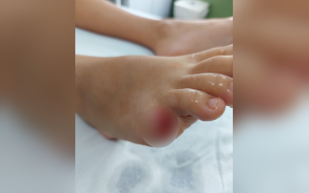 Imagem Ilustrando a Notícia: Após ser atacada por piranha, criança perde dedo mindinho em Buriti Alegre; entenda a história