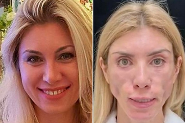Imagem Ilustrando a Notícia: Após cirurgia plástica, Miss Russa não consegue fechar os olhos e nem sorrir