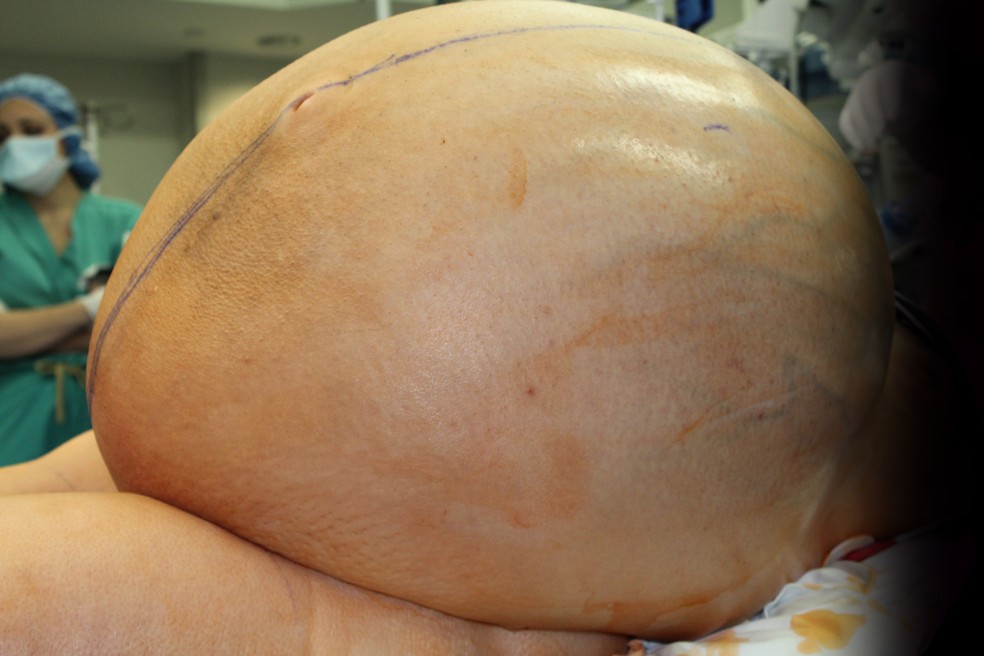 Imagem Ilustrando a Notícia: Tumor de quase 50 quilos é removido do abdômen de mulher na Índia