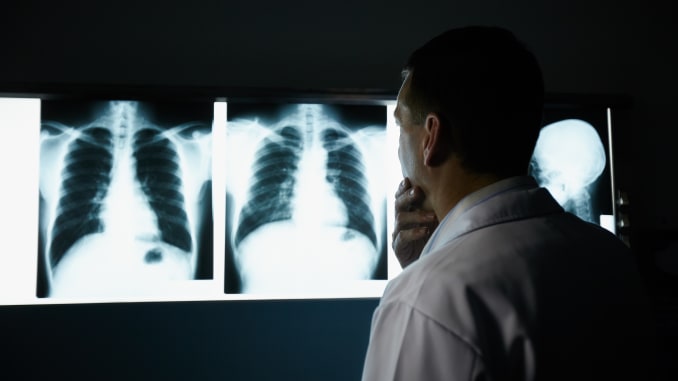 Imagem Ilustrando a Notícia: Médico alerta para riscos da tuberculose pulmonar não tratada