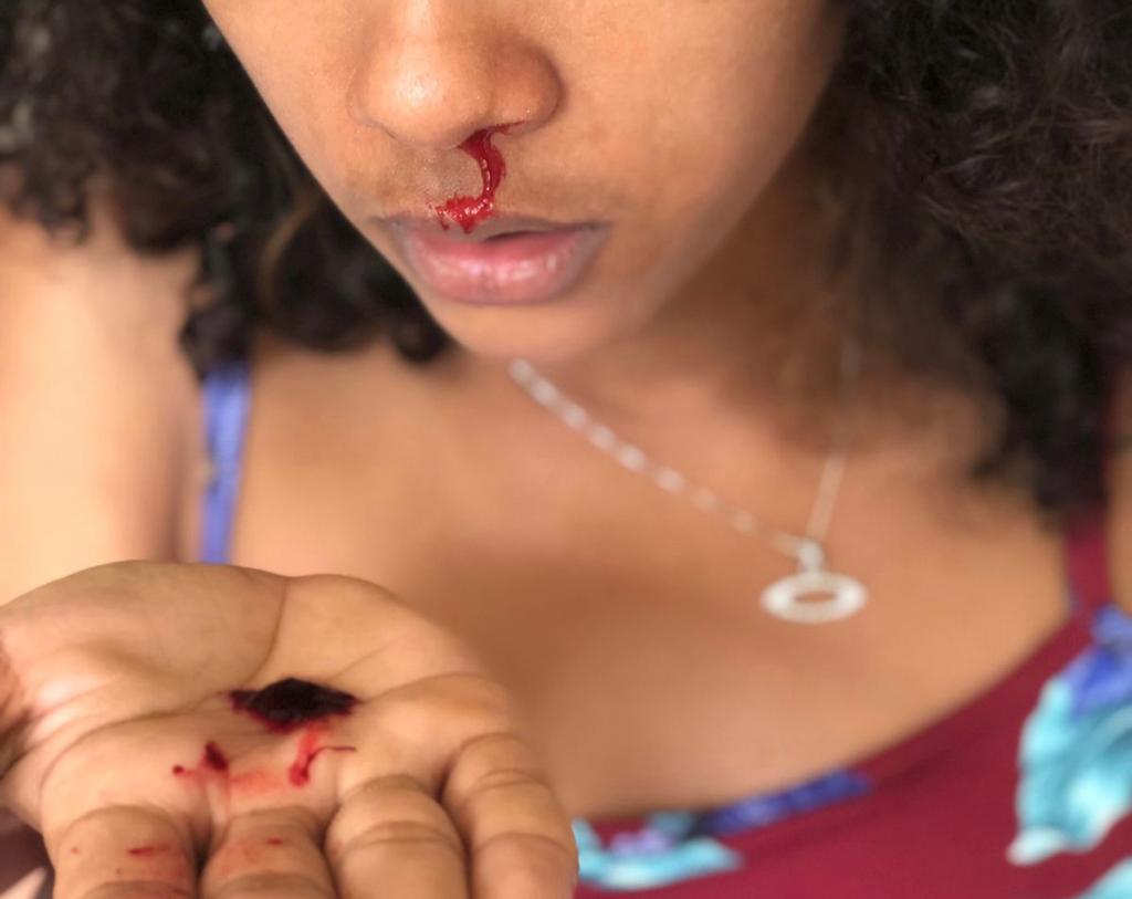 Imagem Ilustrando a Notícia: Jovem fica com nariz sangrando após teste rápido para Covid-19 em Cais de Goiânia