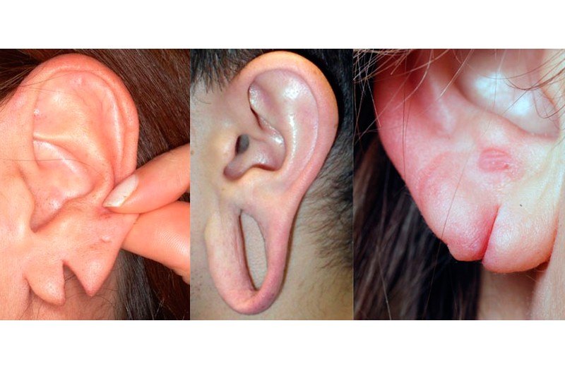 Imagem Ilustrando a Notícia: Ornamentos auriculares podem aumentar o risco de rasgos na orelha