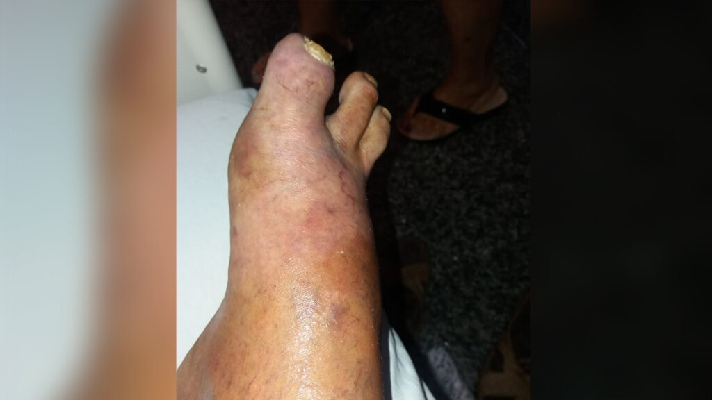 Imagem Ilustrando a Notícia: Por atrasos da SMS de Goiânia, paciente que aguarda por cirurgia pode ter perna amputada