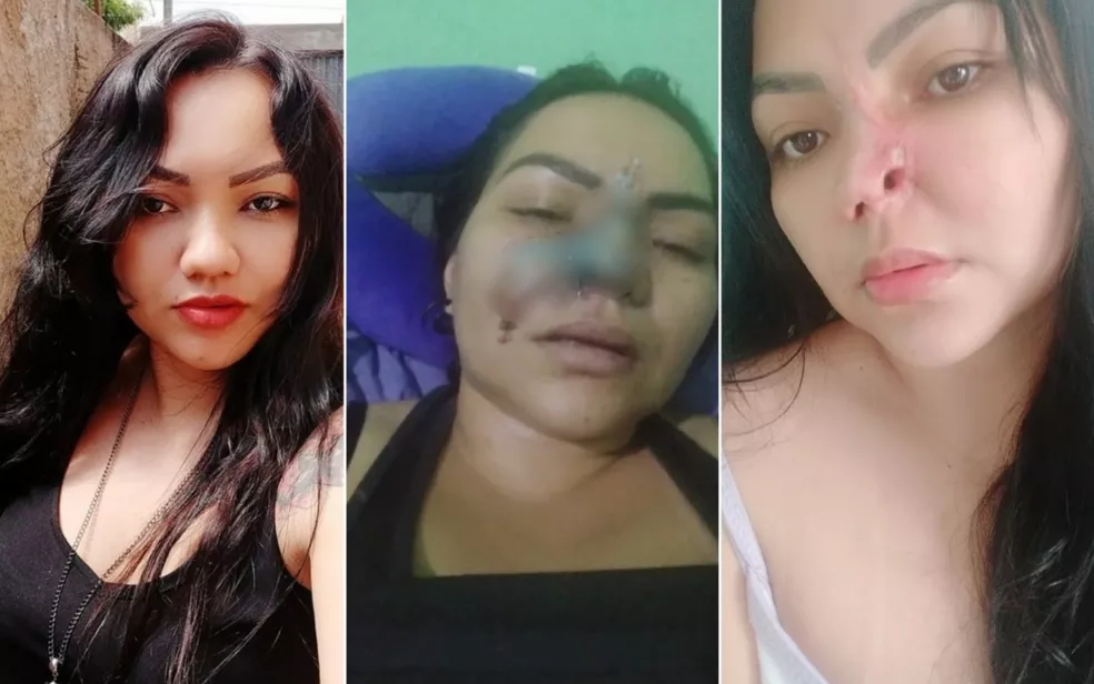 Imagem Ilustrando a Notícia: ‘Meu rosto começou a queimar’ conta mulher que perdeu parte do nariz em cirurgia estética feita por dentista