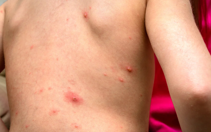 Imagem Ilustrando a Notícia: Pediatra alerta sobre os sintomas da varíola em crianças; confira