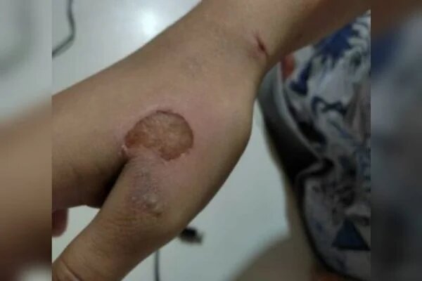 Imagem Ilustrando a Notícia: Homem é preso após torturar, espancar e atear fogo na mão da companheira, em Goiânia