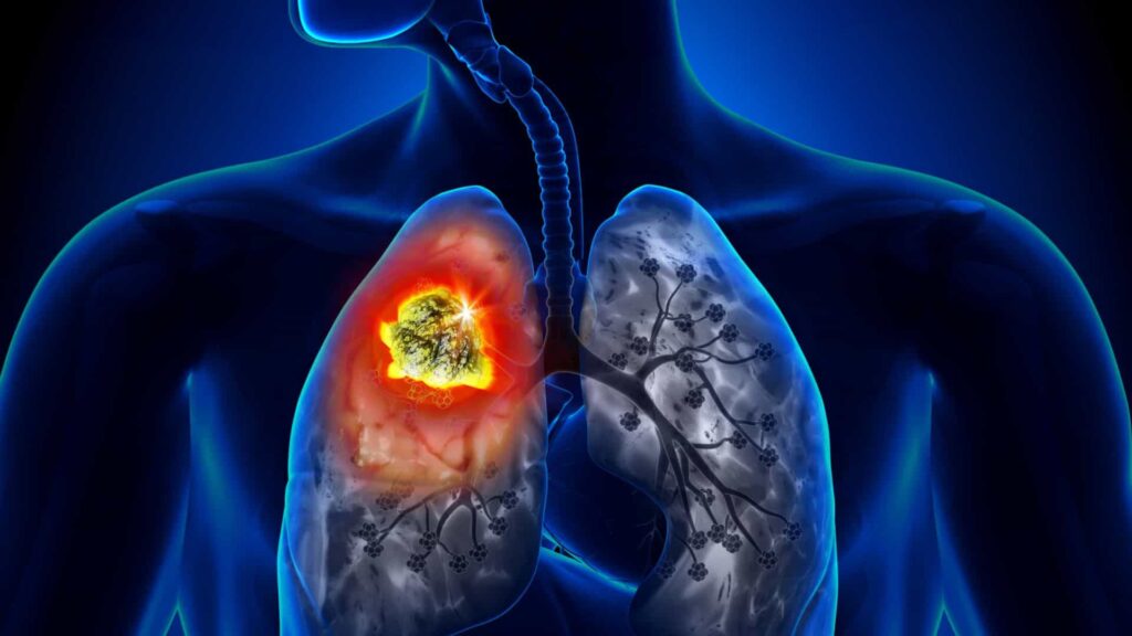 Imagem Ilustrando a Notícia: Fumo é causador de 90% dos casos de câncer no pulmão, aponta INCA