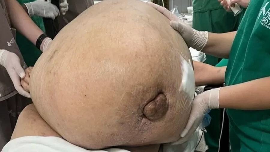 Imagem Ilustrando a Notícia: Mulher tem tumor de 46 kg retirado no Rio de Janeiro; “maior tumor que eu já operei”