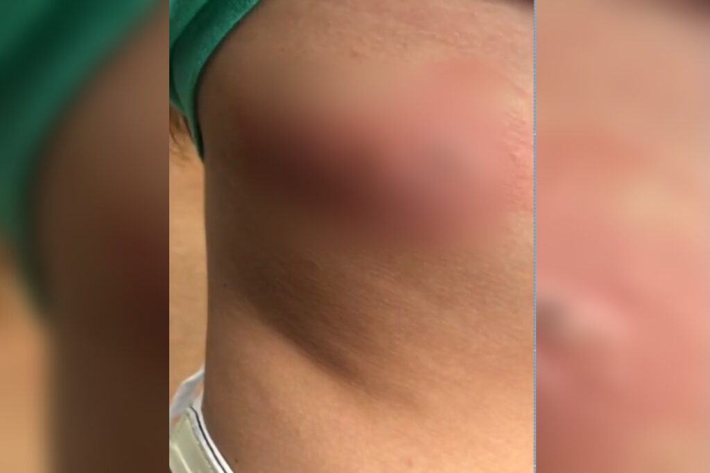 Imagem Ilustrando a Notícia: Adolescente sofre queimaduras após sair de brinquedo no Mutirama, em Goiânia