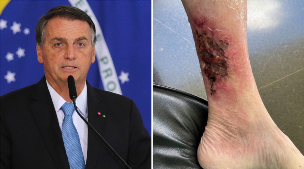 Imagem Ilustrando a Notícia: Em grupo de apoiadores, Carlos posta foto da perna de Bolsonaro com erisipela