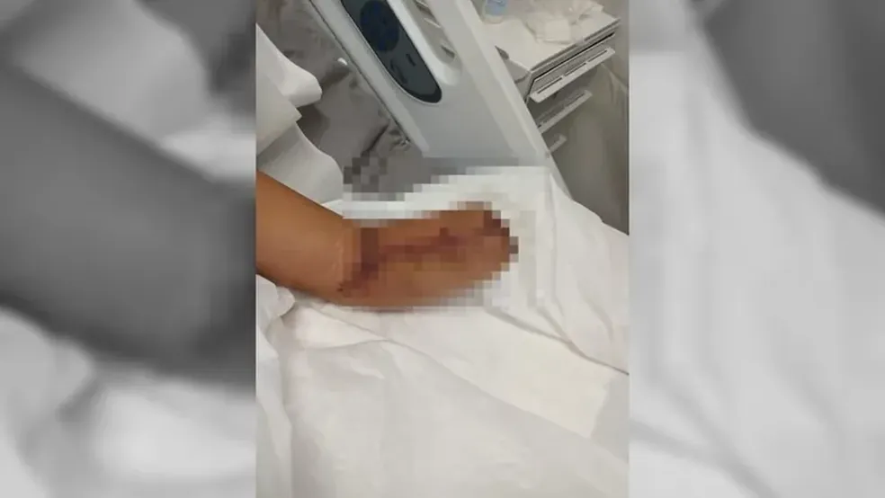 Imagem Ilustrando a Notícia: Entenda o que levou à amputação da mão de mulher que estava em trabalho de parto no RJ, segundo hospital
