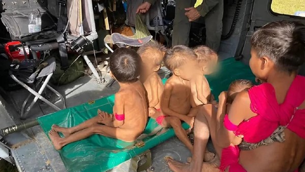 Imagem Ilustrando a Notícia: Crianças yanomamis são intubadas em UTI de Boa Vista com desnutrição grave