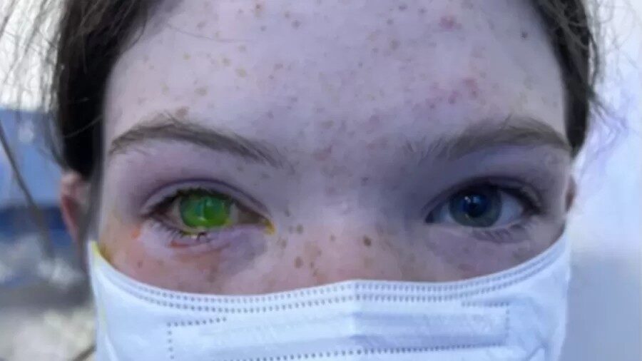 Imagem Ilustrando a Notícia: O que é o “olho de Natal”, doença causada por besouro e que pode causar dor parecida com a do parto