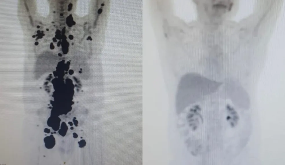Imagem Ilustrando a Notícia: Paciente que lutava há 13 anos contra câncer é curado com tecnologia experimental do SUS