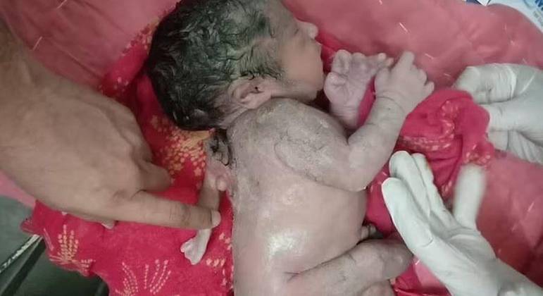 Imagem Ilustrando a Notícia: Bebê nasce com terceiro braço nas costas, na Índia