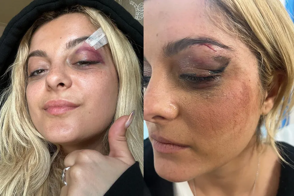 Imagem Ilustrando a Notícia: Bebe Rexha tem rosto atingido após fã arremessar celular em show; cantora mostra os danos na região atingida
