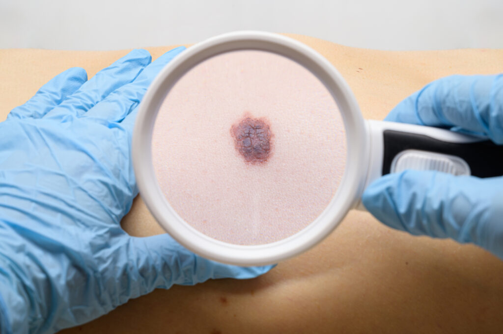 Imagem Ilustrando a Notícia: Tecnologia nova do SUS é capaz de diagnosticar e tratar câncer de pele no mesmo dia