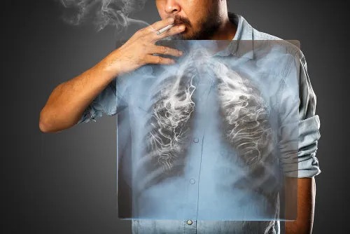 Imagem Ilustrando a Notícia: Tabagismo é responsável por cerca de 85% dos casos de câncer de pulmão