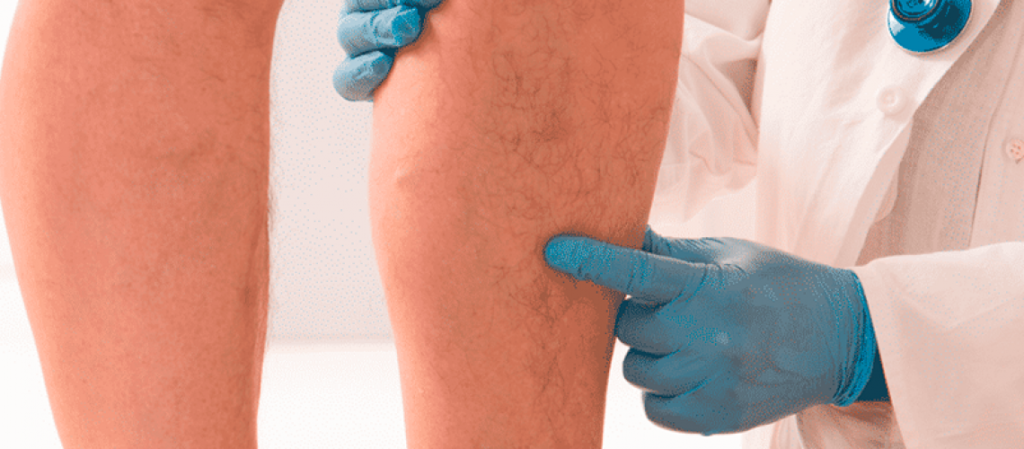 Imagem Ilustrando a Notícia: 80% dos casos de trombose acomete as pernas dos pacientes