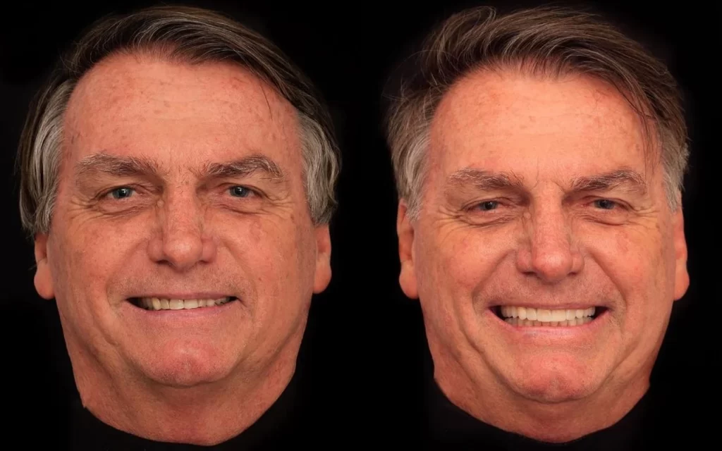 Imagem Ilustrando a Notícia: Jair Bolsonaro realiza procedimento de harmonização facial e reestruturação dentária em Goiânia
