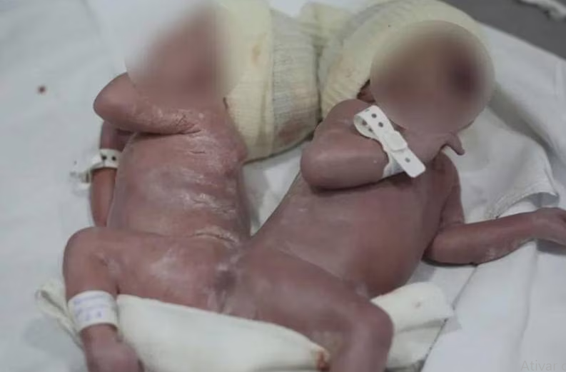 Imagem Ilustrando a Notícia: Caso raro: Gêmeos siameses nascem unidos por osso da coluna, no Paraná