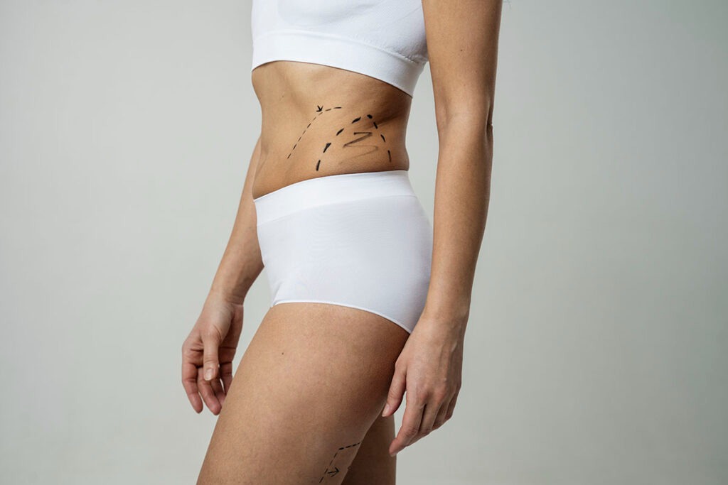 Imagem Ilustrando a Notícia: Bodytite: tecnologia com radiofrequência garante remoção de gordura e firmeza da pele