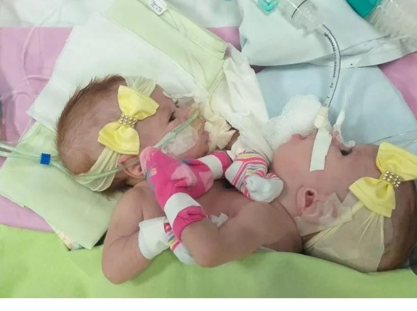 Imagem Ilustrando a Notícia: Gêmeas siamesas passam por cirurgia cardíaca em Goiânia