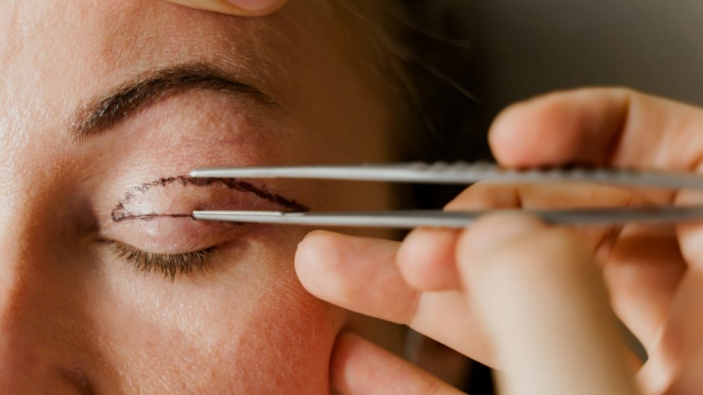 Imagem Ilustrando a Notícia: Blefaroplastia: rejuvenescimento do olhar e melhora na visão