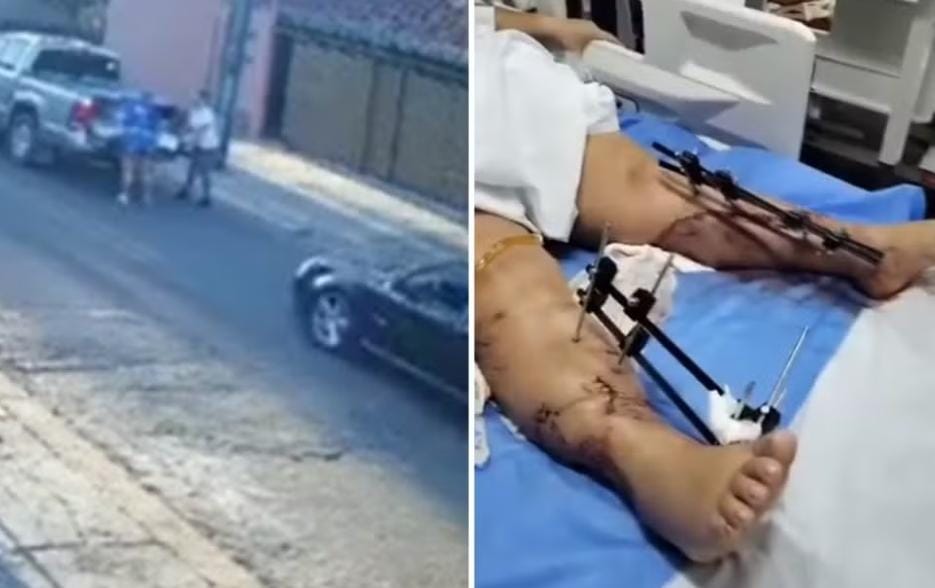 Imagem Ilustrando a Notícia: Mulher tem pernas fraturadas após ser prensada entre carros