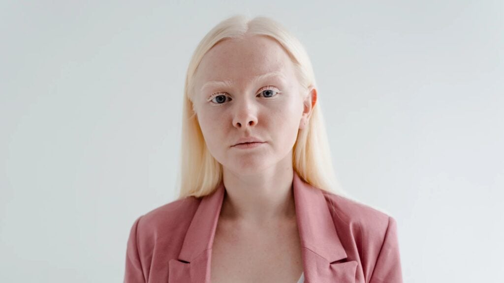 Imagem Ilustrando a Notícia: Albinismo: o que é e quais cuidados devem ser tomados