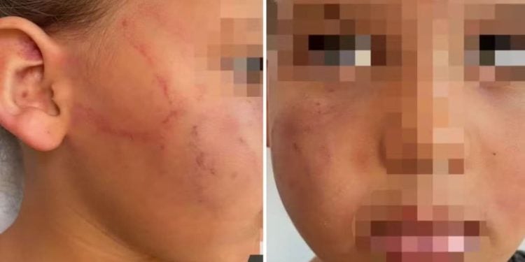 Imagem Ilustrando a Notícia: Mãe que agrediu filha de 4 anos com mordidas possui outro histórico de violência, diz polícia