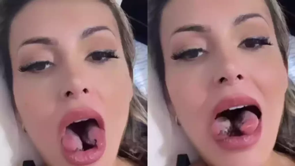 Imagem Ilustrando a Notícia: Entenda o que é o procedimento feito por Andressa Urach; “língua de cobra”