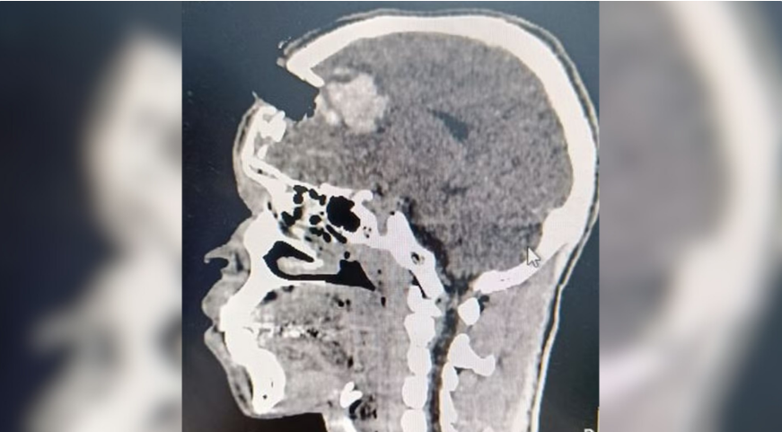 Imagem Ilustrando a Notícia: Homem tem crânio perfurado por pedaço de madeira durante o trabalho