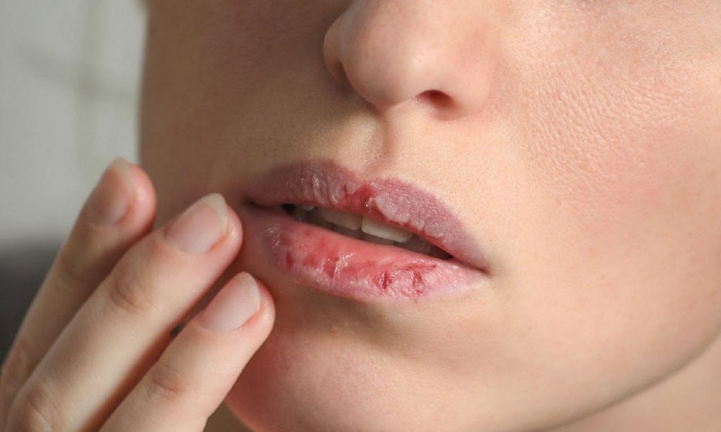 Imagem Ilustrando a Notícia: 5 dicas para evitar lábios ressecados