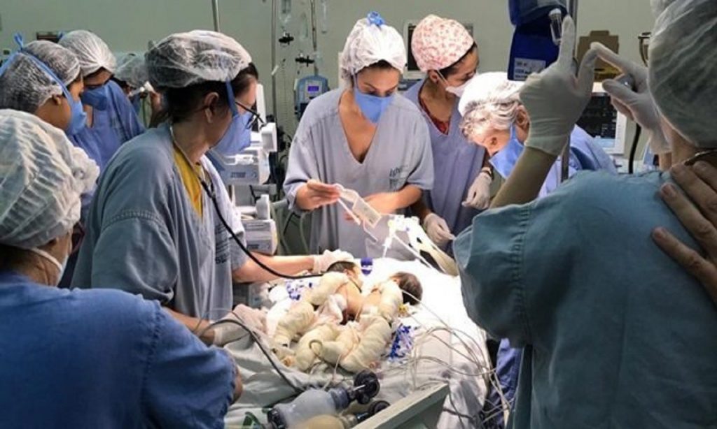 Imagem Ilustrando a Notícia: Morre uma das gêmeas siamesas durante cirurgia chefiada por médico goiano