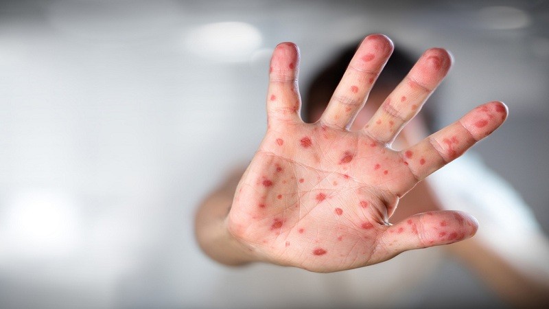 Imagem Ilustrando a Notícia: Brasil tem 1.053 casos de sarampo confirmados