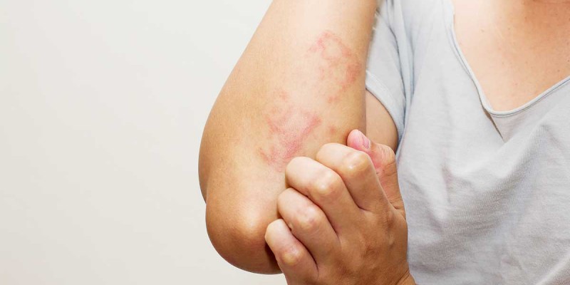 Imagem Ilustrando a Notícia: Dermatite atópica, doença que atinge até 25% das crianças